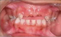  ?? (Photos DR) ?? Dans les cas de carie précoce de l’enfance les plus sévères (ici un enfant de  ans), les lésions curieuses cavitaires fragilisen­t les dents atteintes, qui se fracturent.