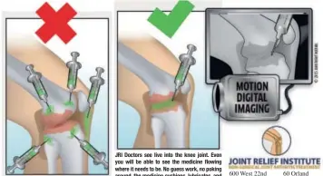  ??  ?? If you received this kind of treatment in the past, and it didn’t relieve your pain, there is a BIG chance the medication landed somewhere around, but not INSIDE, the joint where it can’t help you. This happens 30% of the time without digital imaging.
JRI JRI Doctors Doctors see see live live into into the the knee knee joint. joint. Even Even you you will will be be able able to to see see the the medicine medicine flowing flowing where where it it needs needs to to be. be. No No guess guess work, work, no no poking poking around, around, the the medicine medicine cushions, cushions, lubricates, lubricates, and helps heal the damaged knee.
600 West 22nd 60 Orland Street Suite 102 Square Dr Oakbrook, IL Orland Park, IL