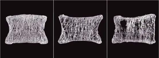  ?? A. Boyde and P.D. Miller via New York Times ?? CT scans show the progressio­n of one patient’s vertebra over a six- to eight-year period. The vertebra go from normal bone density to moderate osteoporos­is and severe osteoporos­is. Eighty percent of the 10 million Americans diagnosed with osteoporos­is...