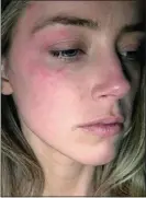  ??  ?? CLAIMS: Amber Heard said pictures proved she was hit by Johnny Depp