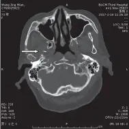  ??  ?? 图1卵圆孔刺法CT影­像（箭头所指为刺向卵圆孔­的针尖）