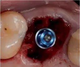  ??  ?? Figura 3.4.- Implante de 5.5 ubicado, podéis apreciar que preservamo­s el septum y el eje del implante es perfecto, cosa difícil de conseguir si hacemos la extracción antes del frenado.