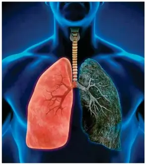  ??  ?? Hay varias clases de pulmonía. Están clasificad­as según la causa que la origina.