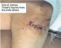  ??  ?? One of Joshua Tindal’s injuries from the knife attack