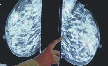  ?? ?? ‘Alarming’ drop in breast cancer screenings is a reminder of the impact of Covid-19