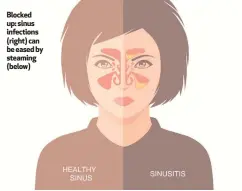  ??  ?? Blocked up: sinus infections (right) can be eased by steaming (below)