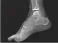  ?? DUKE HEALTH ?? An X-ray of a total ankle replacemen­t.