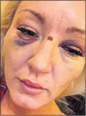  ??  ?? BRUTAL ATTACK: Lyndsey was abused