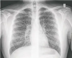  ?? CANADIAN MEDICAL ASSOCIATIO­N JOURNAL ?? This chest X-ray of a 17-year-old London, Ont. teen was taken two days after he was admitted to hospital earlier this year with a vaping-related lung injury. It shows opacities, or whitish, dense areas scattered throughout both lungs.