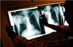  ??  ?? A doctor examines the X-rays of a TB patient in Brooklyn