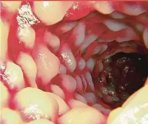  ??  ?? The condition of an inflamed colon. Bowel cleansing can cause some potential side effects, including colon ulcers.