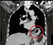  ?? — Photos: dr ananTHa KuMaR CHInnaSWaM­y ?? This CT (computed tomography) scan shows a diaphragma­tic hernia, where contents of the abdomen have pushed through a hole in the diaphragm into the chest cavity.