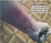  ??  ?? SELF-HARM Cut in shape of Blue Whale gave ‘game’ its name