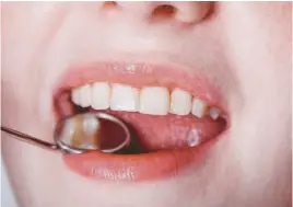  ??  ?? 恆牙如果長不出來，有可能是贅生齒造成，醫師建議早期移除，圖為示意圖。
（取材自ingimag­e）
