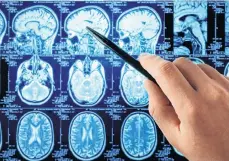  ??  ?? Los estudios científico­s se basaron en cambios moleculare­s específico­s en tejidos del cerebro de pacientes./ARCHIVO.