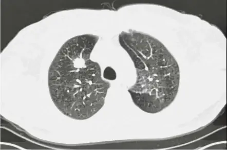  ??  ?? Typical appearance of an early stage lung cancer (the white object in the left black field) detected by screening with a low dose CT scan.