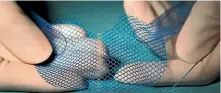  ?? EMILY CRITCHFIEL­D/ DUKE HEALTH ?? The United States FDA has banned pelvic organ prolapse mesh products – but not other mesh products for stress urinary incontinen­ce and hernias.