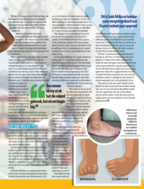  ??  ?? LINKS: Dís hoe Charné se voet nou ná talle operasies lyk. ONDER: Die illustrasi­e wys hoe ’n clubfoot lyk vergeleke met ’n normale voet. NORMAAL CLUBFOOT