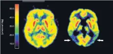  ?? FOTO: DPA ?? Die mit der Positronen-Emissions-Tomografie (PET) erstellte Abbildung zeigt zwei Gehirne – links ein gesundes, rechts ein an Alzheimer erkranktes.