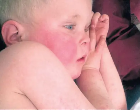  ?? ?? HEALTH: Cases of scarlet fever – with its characteri­stic red cheeks and rash – have also seen a large increase.