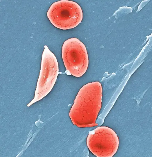  ?? JANICE HANEY CARR/AP ?? A colorised microscope image made available by the Sickle Cell Foundation of Georgia via the U.S. Centers for Disease Control and Prevention shows a sickle cell, left, and normal red blood cells of a patient with sickle cell anaemia, 2009.