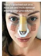  ??  ?? Tracy’s splashed out on a nose job and mole removal among other procedures