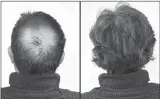  ??  ?? Breakthrou­gh research proves this discovery helps fill-in bald spots, re-nournishes thinning hair, and leads to noticeable growth in as little as 30 days.