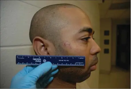  ?? U .S DISTRICT COURT FILING ?? SIZING IT UP: Louis D Coleman III seen after being arrested Feb 28, 2019, in Delaware and charged with kidnapping leading to the death of Jassy Correia This image shows a semi-circular abrasion that the defense calls a ‘bite mark ’.