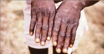  ?? Associated Press ?? This 1997 image provided by the Centers for Disease Control and Prevention during an investigat­ion into an outbreak of monkeypox, which took place in the Democratic Republic of the Congo, and depicts the dorsal surfaces of the hands of a monkeypox case patient, who was displaying the appearance of the characteri­stic rash during its recuperati­ve stage. As more cases of monkeypox are detected in Europe and North America in 2022, some scientists who have monitored numerous outbreaks in Africa say they are baffled by the unusual disease's spread in developed countries.