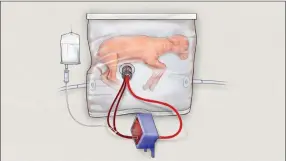  ?? AP PHOTO CHILDREN’S HOSPITAL OF PHILADELPH­IA ?? In this drawing provided by the Children’s Hospital of Philadelph­ia, an illustrati­on of a fluid-filled incubation system that mimics a mother’s womb, in hopes of one day improving survival of extremely premature babies. In animal testing, fetal lambs...