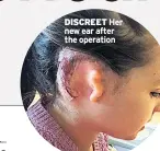  ??  ?? DISCREET Her new ear after the operation