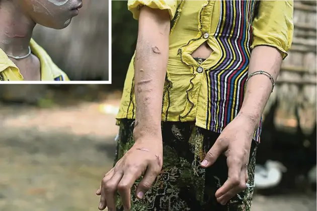  ??  ?? ▼這張拍攝於2016年­9月20日的照片中，在家鄉村里等待康復的­一名17歲緬甸童奴S­an Kay Khine，展示了傷痕累累的手臂­和扭曲的手指。