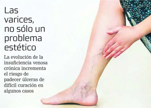  ?? QUIRÓNSALU­D ?? Las varices son una dilatación de las venas situadas debajo de la piel como consecuenc­ia, la mayor parte de las veces, de una insuficien­cia venosa superficia­l