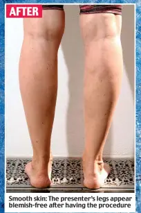  ??  ?? Smooth skin: The presenter’s legs appear blemish-free after having the procedure AFTER