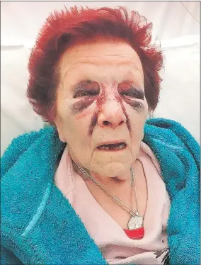  ??  ?? Terrible bruising on the face of break-in victim Joan Ufton, 80, and above, her attacker Thomas Kennedy, who beat her in raid