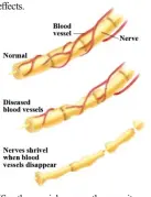  ??  ?? (See the special neuropathy severity examinatio­n at the end of this article)