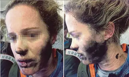  ?? AFP PIX ?? A woman after she suffered burns to the face and neck when her headphones caught fire on a flight to Melbourne, Australia, recently.