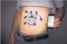  ?? PHOTO COURTESY OF UC SAN DIEGO ?? A wearable device attached to the belly measures stomach activity. The prototype was developed by a team led by UC San Diego researcher­s.