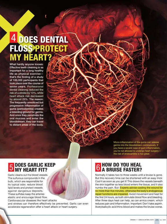  ??  ?? Micro-inflammati­on of the gums can release germs into the bloodstrea­m continuous­ly. If you have a severe case of gum inflammati­on, you’re not allowed to undergo heart surgery— the risk of endocardit­is is too great.