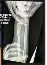  ?? ?? Kardashian shared a photo of Saint’s cast while West posted X-rays