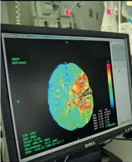  ??  ?? Ictus
Molti pazienti con gravi problemi neurologic­i a causa del coronaviru­s, per alcuni hanno anticipato i problemi di respirazio­ne