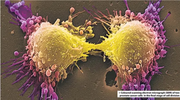  ??  ?? > Coloured scanning electron micrograph (SEM) of two prostate cancer cells in the final stage of cell division