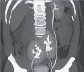  ??  ?? A CT scan showing the man’s three kidneys: two kidneys are fused at the pelvis