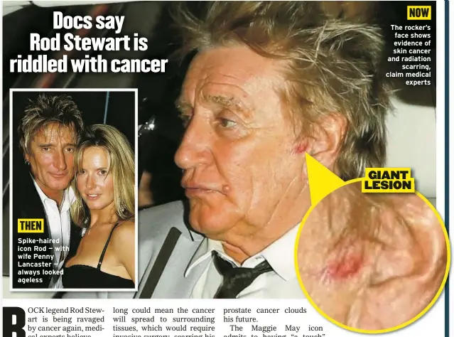  ?? ?? Spike-haired icon Rod — with wife Penny Lancaster — always looked ageless
The rocker’s face shows evidence of skin cancer and radiation
scarring, claim medical
experts
