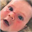  ??  ?? Four-month-old Noah Watson suffered “horrific” blister burns after 50 SPF Cancer Society sunscreen failed to protect him. RIGHT: Lizzy Thompson, 15, with severe sunburn to her back and shoulders.