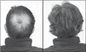  ??  ?? Breakthrou­gh research proves this discovery helps fill-in bald spots, re-nournishes thinning hair, and leads to noticeable growth in as little as 30 days.