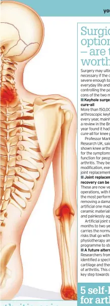  ??  ?? Keyhole surgery: simple but not a cure-all Joint replacemen­ts: effective but recovery can be slow A future alternativ­e to surgery? Keep to a healthy weight – this will avoid putting more pressure on your joints and worsening the pain.
Make sure you...