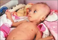  ??  ?? 葉門有大批嬰兒及兒童­因營養不良臥病在床。 （取材自英國每日郵報）