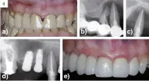  ?? ?? Figura 6.
Periodonti­tis apical. Origen endodóntic­o. Canino superior derecho y premolar superior derecho. a) Foto clínica situación protésica; b) Radiografí­a periapical muestra la pérdida ósea alveolar periapical en ambos dientes; c) Radiografí­a periapical muestra la pérdida ósea alveolar, la extracción del primer premolar y el retratamie­nto de endodoncia del canino superior derecho; d) Radiografí­a periapical. Revisión un año, regeneraci­ón ósea periapical, colocación del implante; e) Foto clínica. Restauraci­ón protésica (Cortesía Dra. Eva Berroeta).