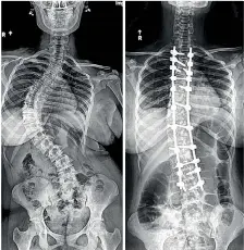  ?? ?? The 100th scoliosis correction: X-rays before and after